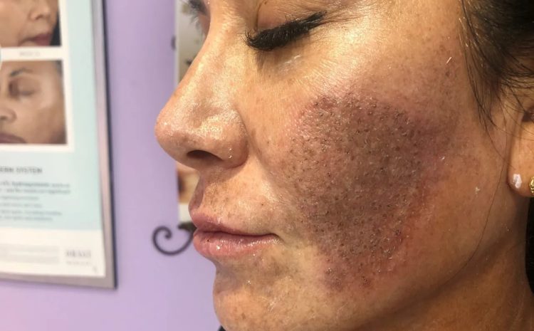  How to Get the Best Results from Microneedling