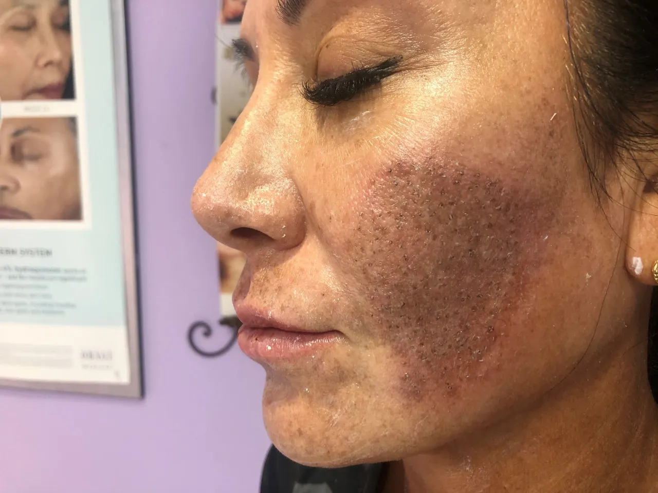 How to Get the Best Results from Microneedling