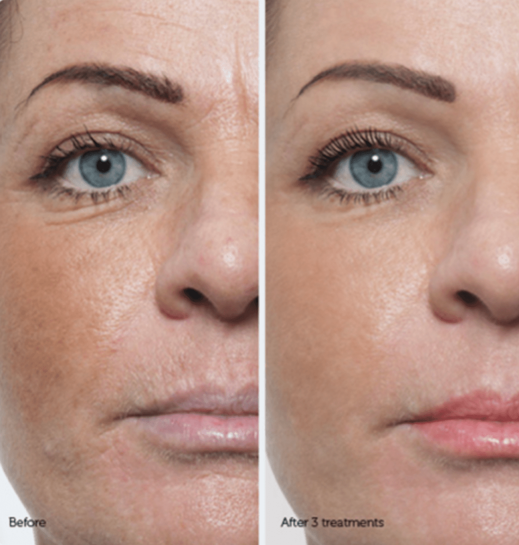 what-is-dermapen