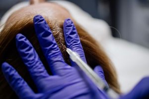 Is It Effective To Use Mesotherapy For Hair Loss?