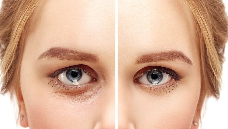  Does PRP Injections Work for Eye Wrinkles and Under-Eye Circles?