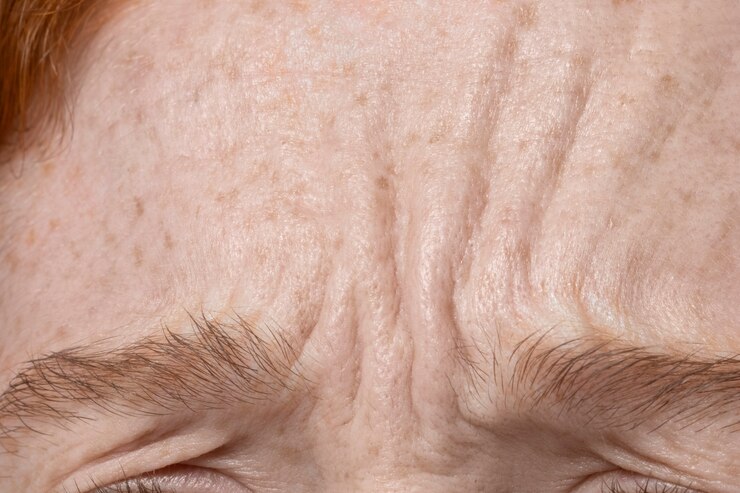 <em>Reduce Your Fine Lines and Wrinkles with PRP Treatment</em>