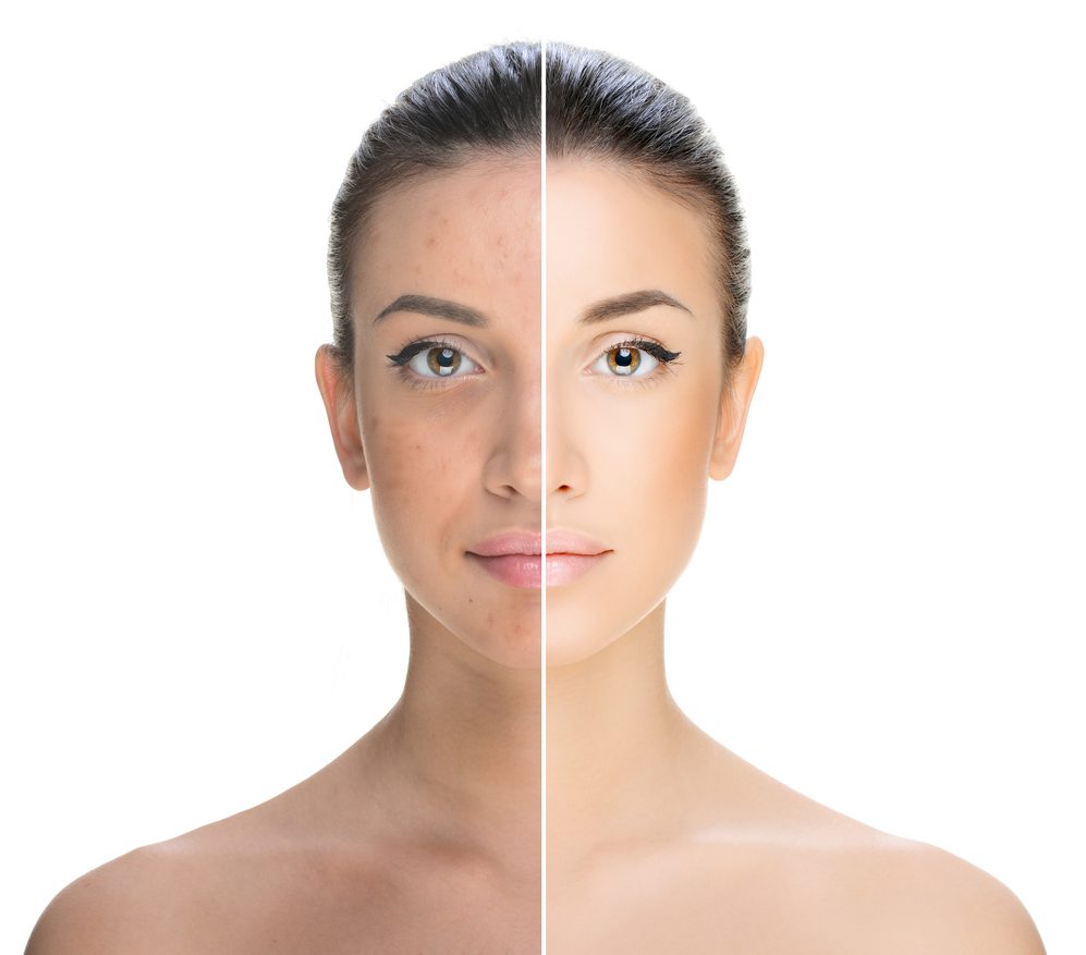 Chemical peel before and after
