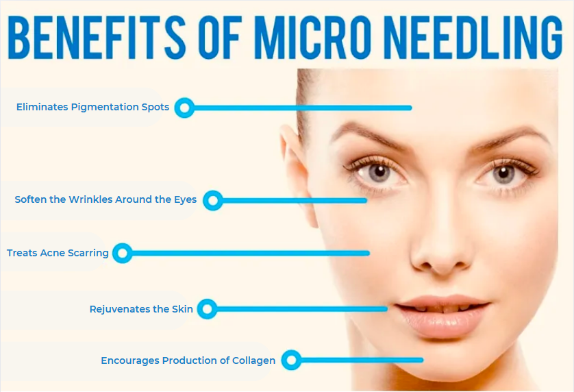 Microneedling Benefits